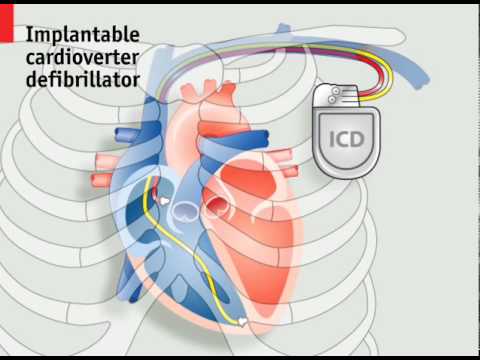 How pacemakers work