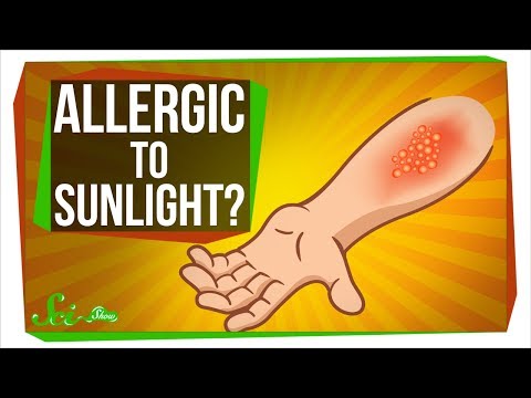 Can You Be Allergic To Sunlight?