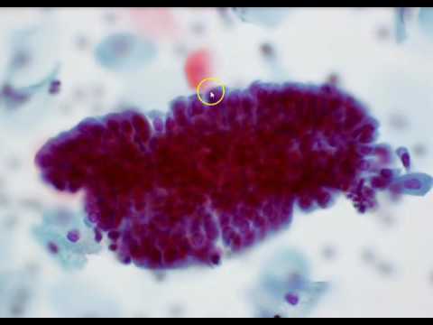 Cervical cytology - Endocervical cells